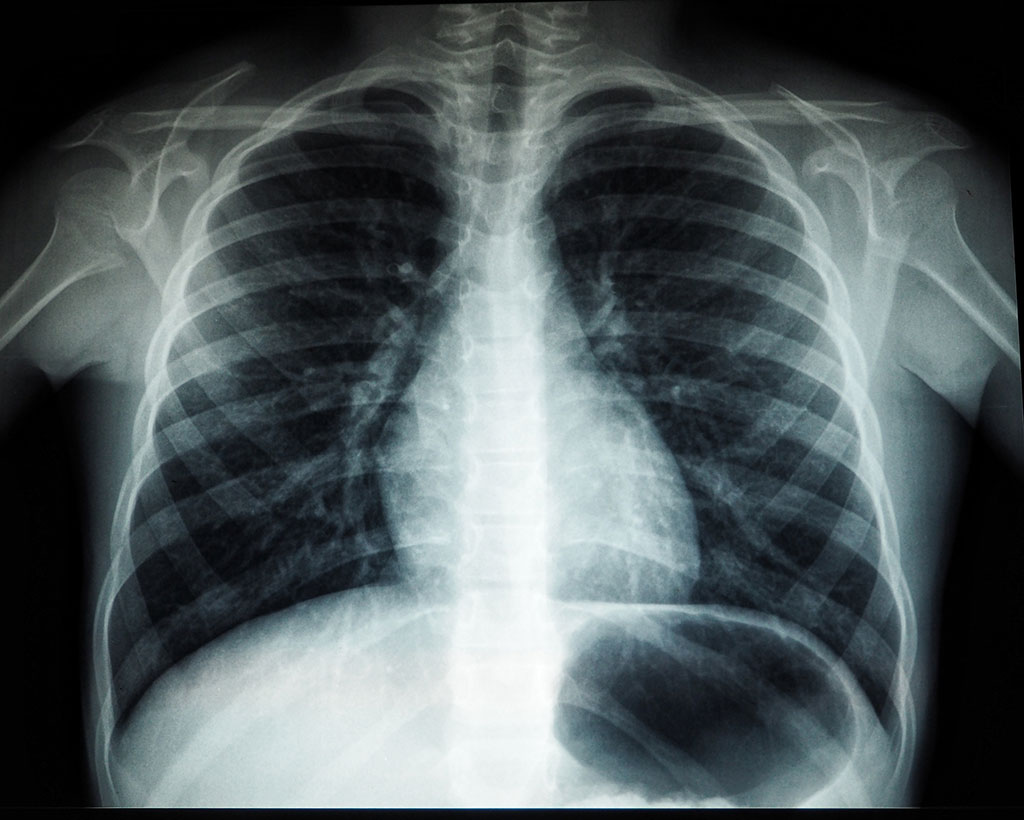 Image: Lung damage may persist long after COVID-19 pneumonia (Photo courtesy of Unsplash)