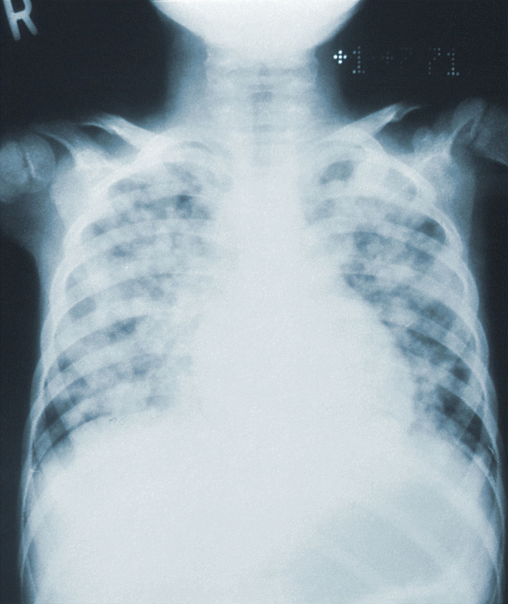 Image: Novel AI-based technology for chest CT analysis of idiopathic pulmonary fibrosis (Photo courtesy of Unsplash)