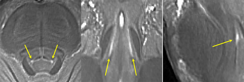 Image: Locus coeruleus as seen in 7T MRI scan (Photo courtesy of University of Cambridge)