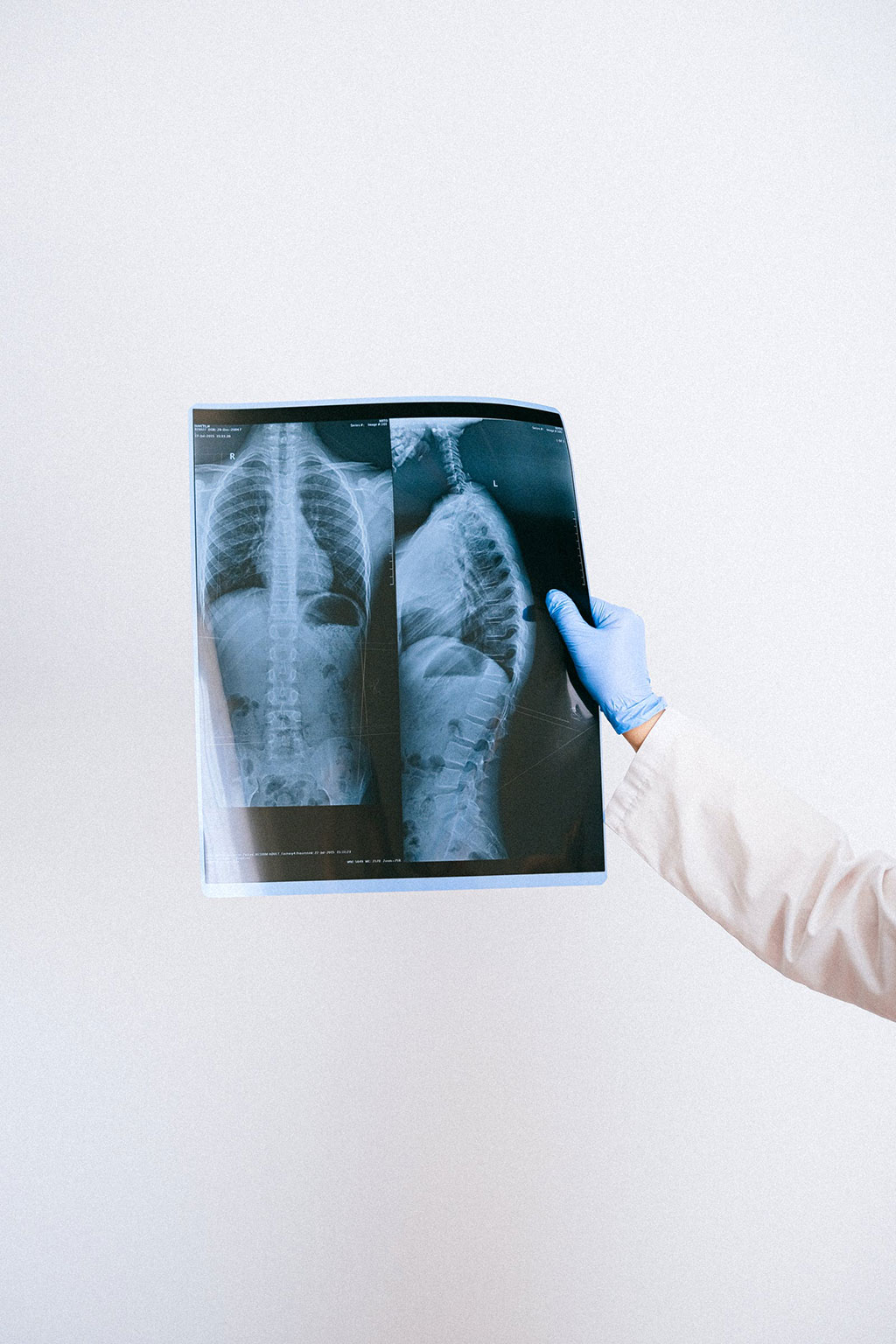 Image: Spinal fractures in the elderly are preventable with simple X-rays (Photo courtesy of Pexels)