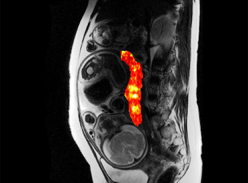 Image: Quantitative T2* mapping during pregnancy can identify placental dysfunction (Photo courtesy of OSHU)