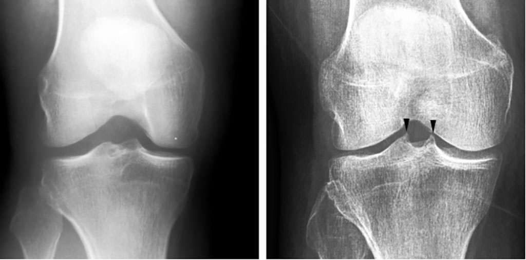 Image: AI tries to detect whether there is spiking on the tibial tubercles in the knee joint or not (Photo courtesy of University of Jyväskylä)