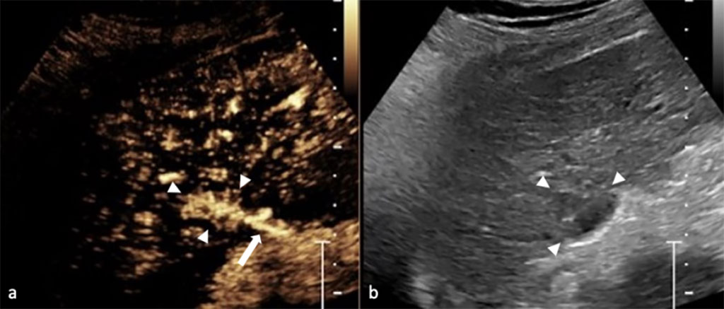 Image: Contrast-enhanced ultrasound vs. conventional ultrasound image (Photo courtesy of ICUS)