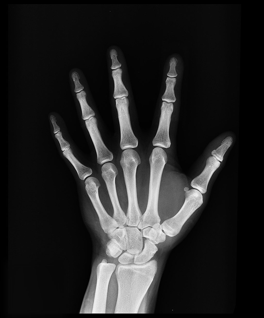 Image: An AI algorithm scored higher marks than emergency physicians at pinpointing fractures (Photo courtesy of Pexels)