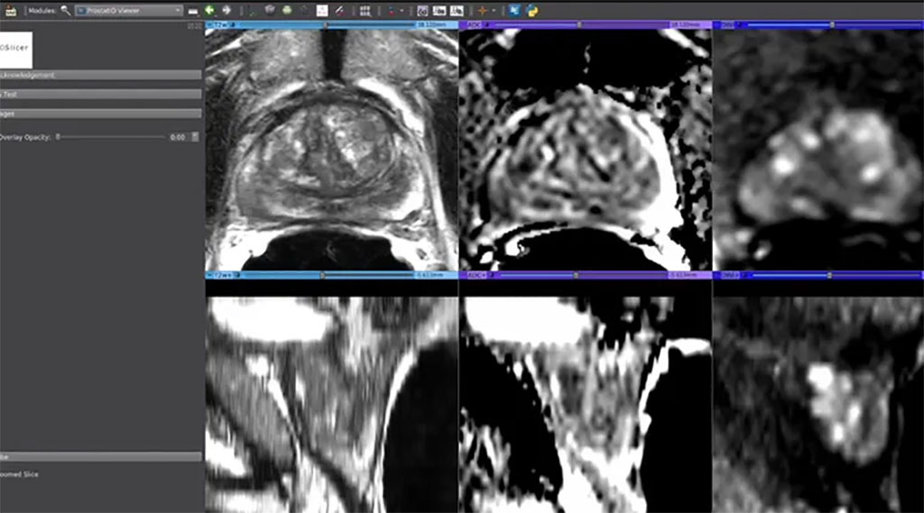 Image: New AI tool can safely delay, as well as inexpensively and accurately monitor prostate cancer treatment (Photo courtesy of Bot Image)