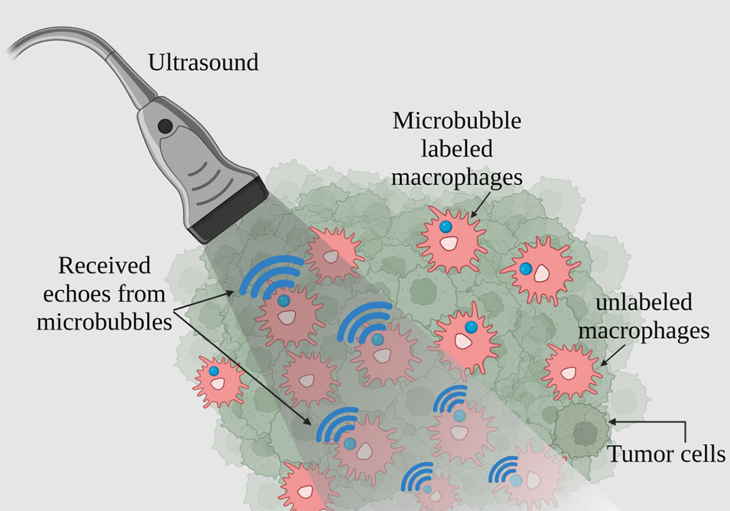 Image: Attaching microbubbles to macrophages can create high-resolution and sensitive tracking images useful for disease diagnosis (Photo courtesy of Georgia Institute of Technology)