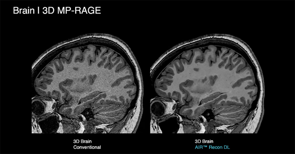 Image: Sonic DL is a groundbreaking, FDA-cleared AI deep learning technology for faster MRI (Photo courtesy of GE HealthCare)