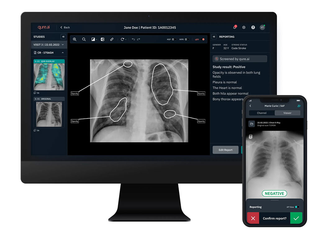 Image: The qXR AI-enabled chest X-ray solution has received 510(k) FDA clearance under two critical findings (Photo courtesy of Qure.ai)