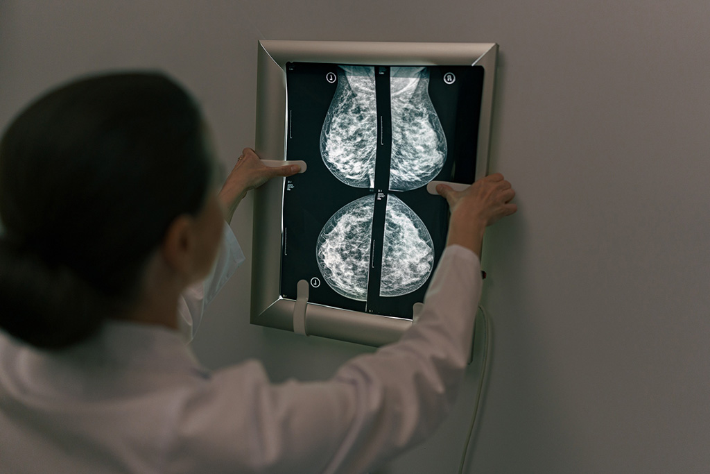 Image: MRI screen-detected breast cancers have been found to be most often invasive cancers (Photo courtesy of 123RF)