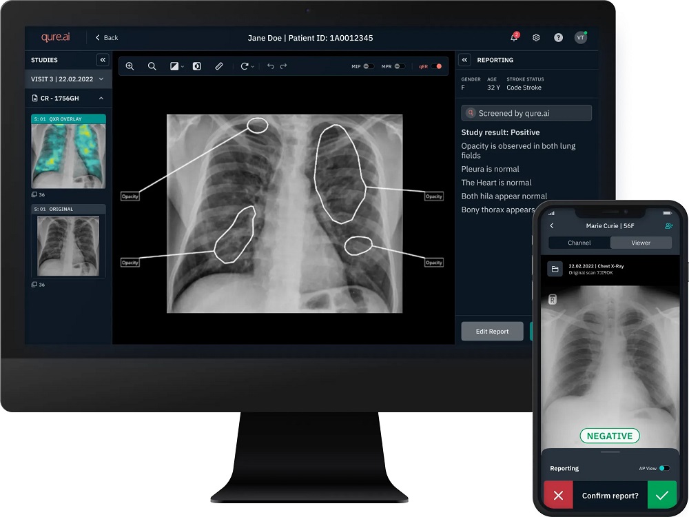 Image: The qXR-CTR chest X-ray solution has received FDA clearance as a potential indicator for identifying heart failure risk (Photo courtesy of Qure.ai)