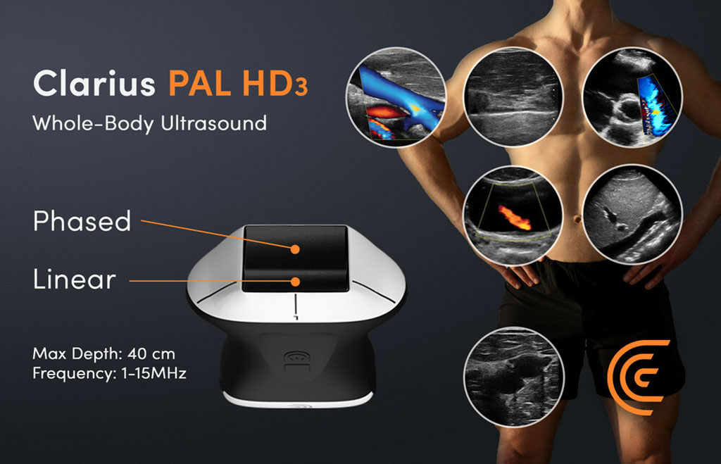 Image: The new Clarius PAL HD3 wireless handheld whole-body ultrasound scanner (Photo courtesy of Clarius)