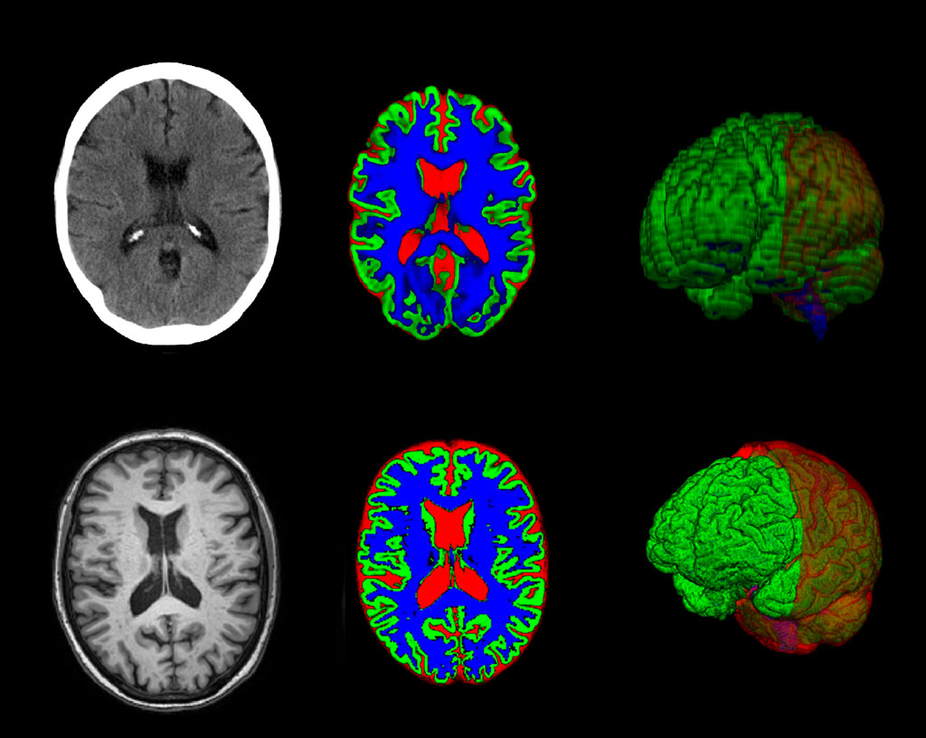 Image: Examples of CT and MR scans of the same patient using the new software (Photo courtesy of University of Gothenburg)