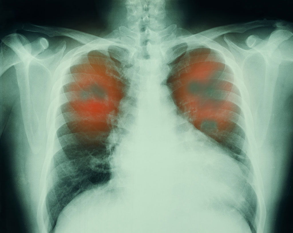 Image: The AI tool can identify non-smokers who are at high risk for lung cancer using a single X-ray (Photo courtesy of 123RF)