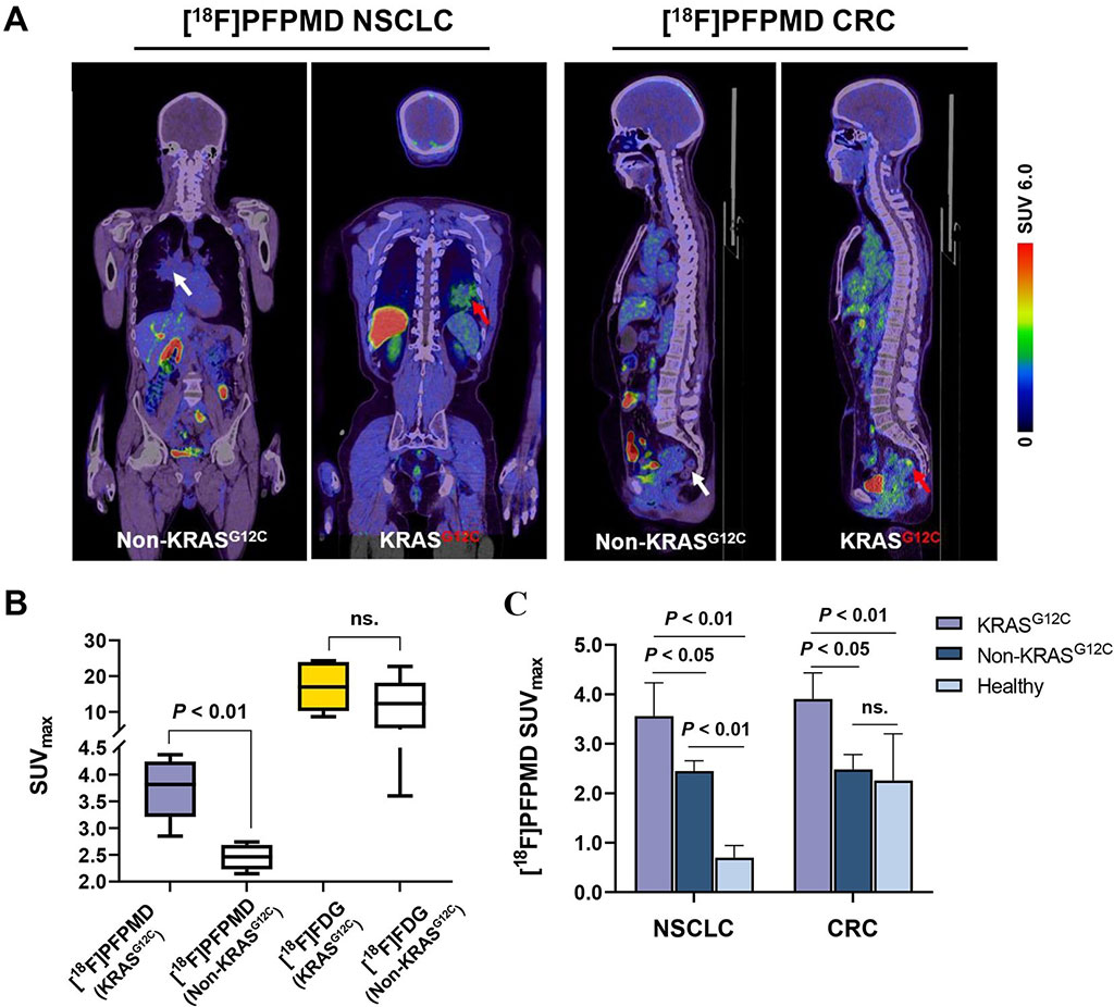 Image: 18F-PFPMD PET/CT imaging of NSCLC and CRC patients (Photo courtesy of SNMMI)