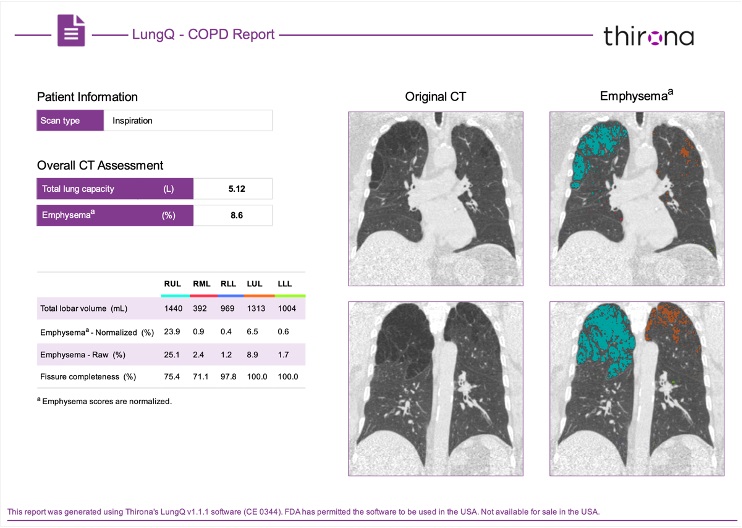 Image: The LungQ v3.0.0 software has received US FDA 510(k) clearance for the AI analysis of chest CT images (Photo courtesy of Thirona)