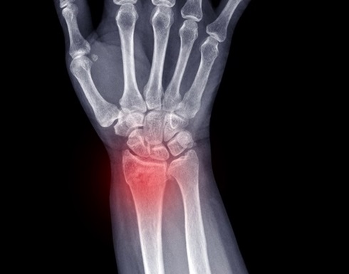 Image: AI algorithms, particularly CNNs, can accurately detect wrist fractures from plain X-rays (Photo courtesy of Adobe Stock)