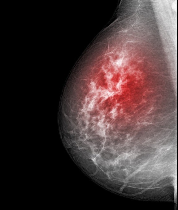 Image: MRI monitoring in women with mutations in BRCA1 genes significantly reduces breast cancer mortality (Photo courtesy of 123RF)