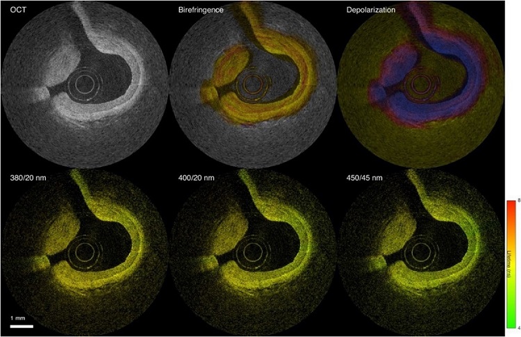 Image: The catheter-based device combines PS OCT (top) and multispectral FLIM (bottom) to provide detailed multimodal view via intravascular imaging (Photo courtesy of UC Davis)