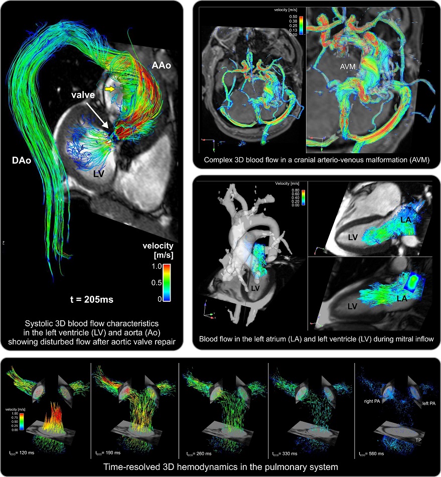 Image: 4D flow MRI enables unobstructed in-vivo assessment of time-resolved 3D blood velocity (Photo courtesy of Northwestern University)
