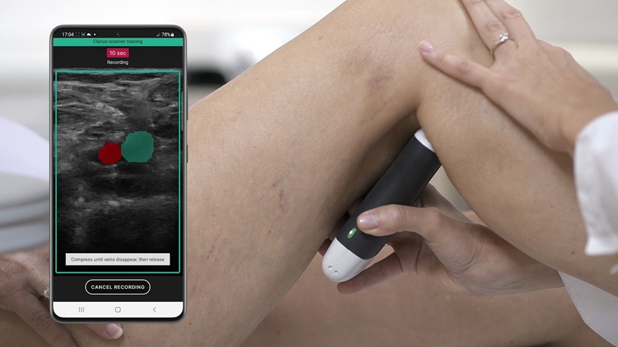 Image: The AI-guided ultrasound system can speed up the diagnosis from several hours to as little as 15 minutes (Photo courtesy of Clarius Mobile Health)