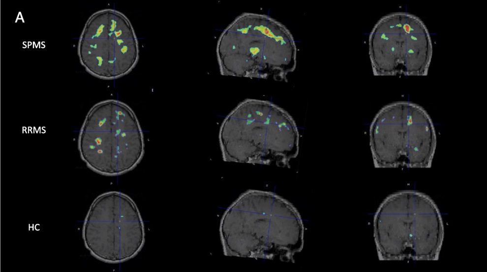 Individualized parametric z-score maps of the brain showing glial activity load on PET (GALP) in the brain, compared among secondary progressive MS (SPMS, top row), relapsing remitting MS (RRMS, middle row), and healthy controls (HC, bottom row) in transaxial, sagittal, and coronal sections (Photo courtesty of Singhal et al., Clinical Nuclear Medicine 2024)