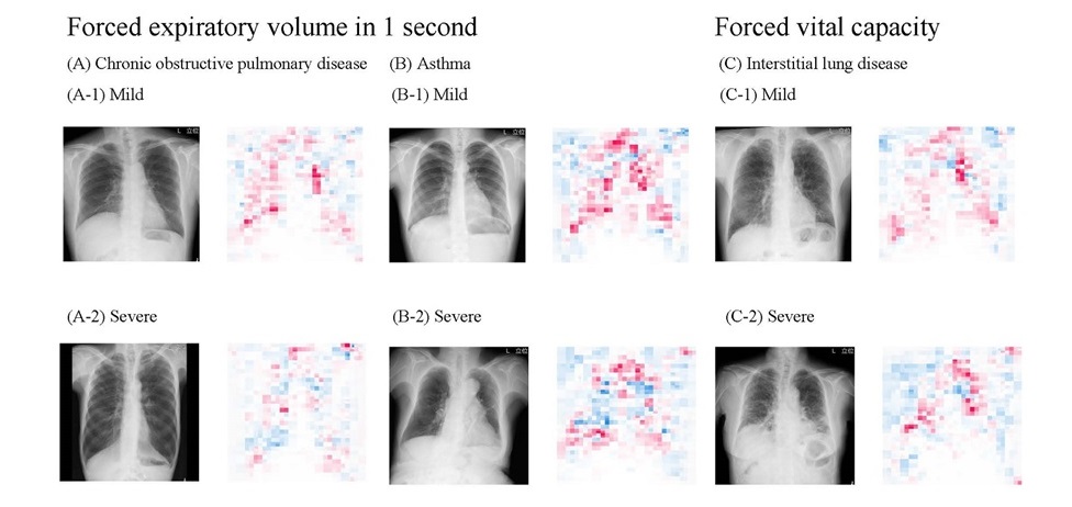 Image: The AI model estimates lung function by observing radiographs, with lower values denoted by blue areas and higher values by red areas in the saliency maps (Photo courtesy of Osaka Metropolitan University)