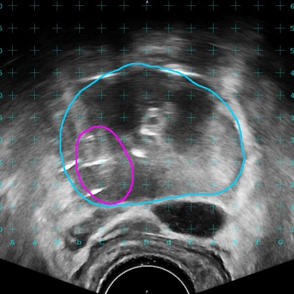 Image: The software allows surgeons to view MR contours on the live ultrasound (Photo courtesy of MIM Software)