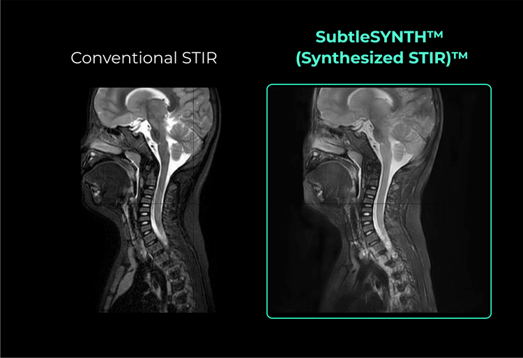 Image: SubtleSYNTH creates synthetic STIR images with zero acquisition time that are interchangeable with conventionally acquired STIR images (Photo courtesy of Subtle Medical)