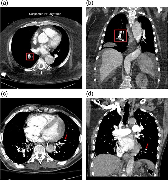 Image: The AI-based solution was able to detect 76% of PE cases initially missed in CTPA clinical reports (Photo courtesy of Angela Ayobi, et al.; doi.org/10.1016/j.clinimag.2024.110245)