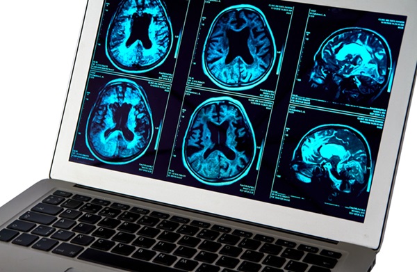 Image: The new AI software could make diagnosing dementia easier and faster for doctors (Photo courtesy of 123RF)