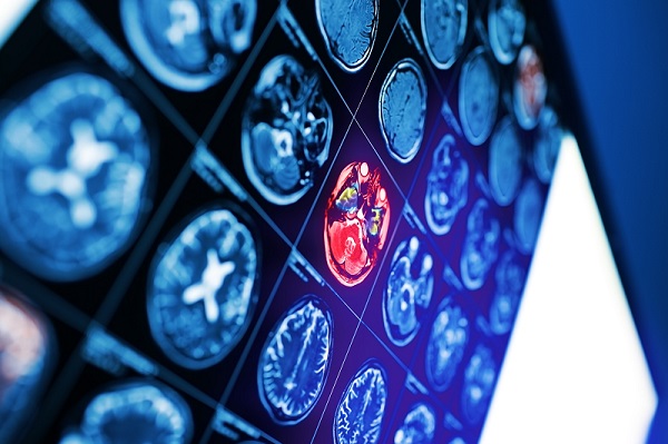 Image: A new paradigm in radiation therapy planning aims to improve treatment outcomes for children with brain tumors (Photo courtesy of 123RF)