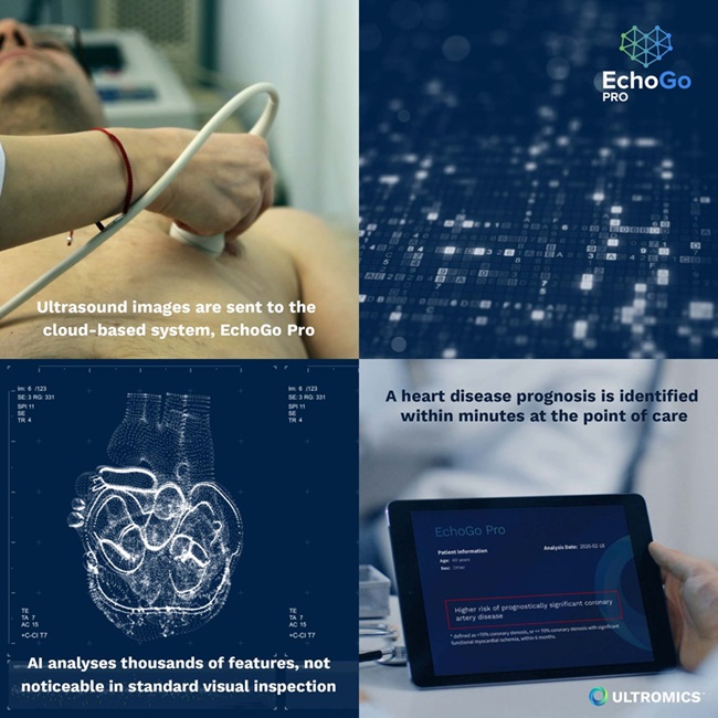 Image: The EchoGo Pro uses AI technology to accurately and instantly predict heart disease risk through non-invasive ultrasound analysis (Photo courtesy of Ultromics)