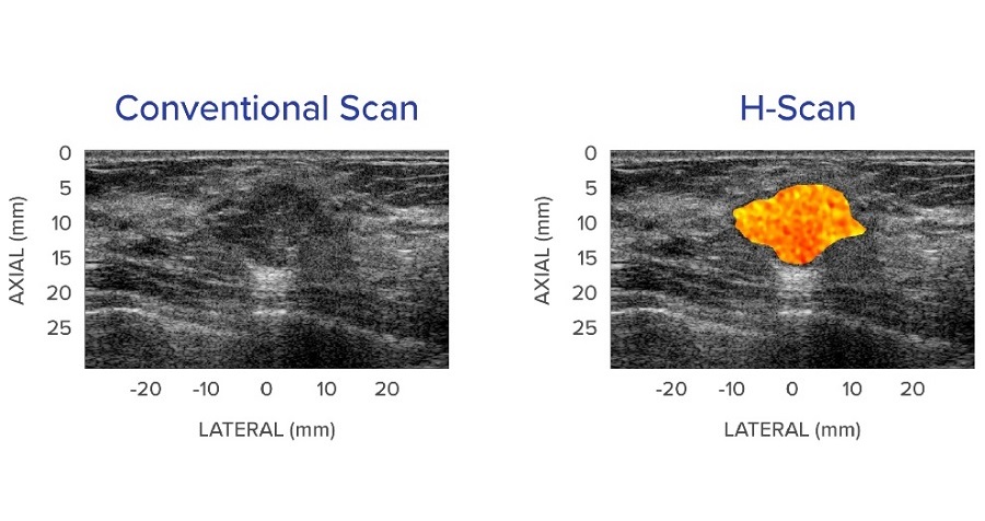 Image: An example of a conventional ultrasound B-scan showing a suspicious breast lesion (left image) and with the new H-scan analysis showing the possibly malignant mass in color (right image) (Photo courtesy of Jihye Baek)