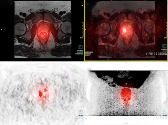 Image: A study has shown long-term benefits of PSMA-PET in patients with recurrent prostate cancer (Photo courtesy of 123RF)