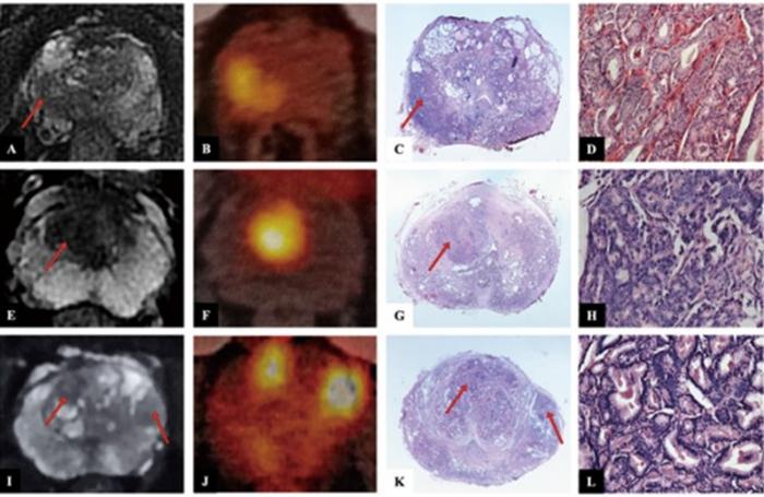 Image: MRI prostate-specific membrane antigen PSMA PET-CT) and hematoxylin & eosin staining imaging of three representative cases (Photo courtesy of Professor Nianzeng Xing. DOI: 10.1097/CM9.0000000000003204)
