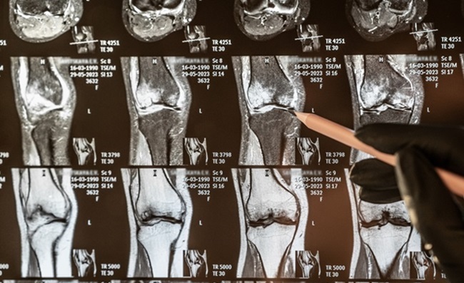 Image: The deep learning model can assist with classifying 12 common types of knee abnormalities (Photo courtesy of 123RF)