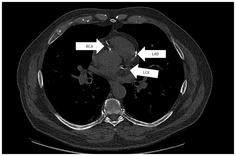 Image: Transaxial image of a lung cancer screening CT scan showing coronary artery calcium in all three coronary arteries (Photo courtesy of CMAJ DOI/10.1503/cmaj.231602)