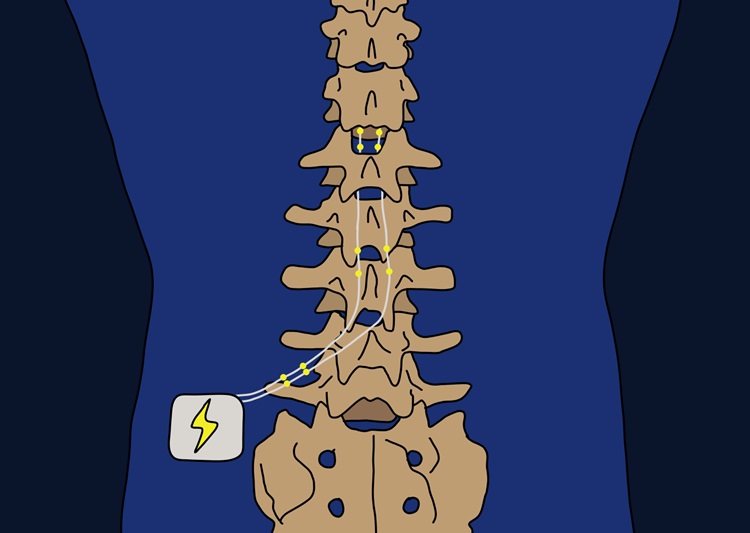 Image: Spinal cord stimulation is an invasive and risky procedure that is not effective for all patients (Photo courtesy of Kobe University)