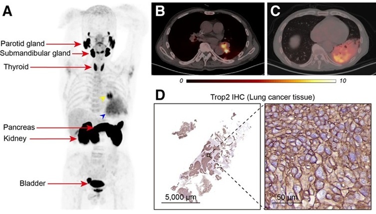 Image: [18F]AlF-RESCA-T4 immuno-PET/CT imaging of patient with primary lung cancer (Photo courtesy of Jiao Tong University)