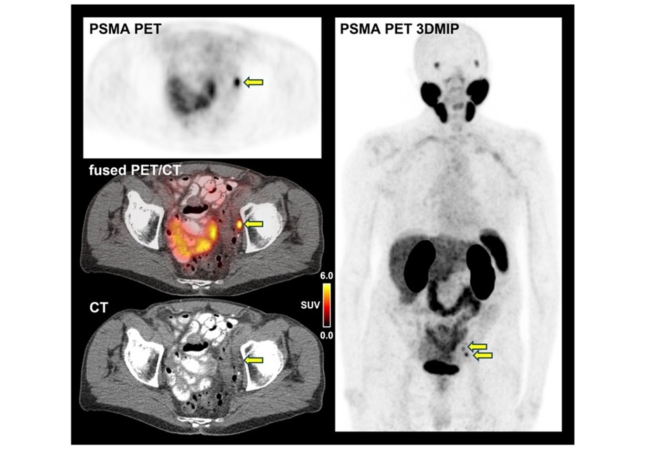 Image: PSMA-PET/CT images of an 85-year-old patient with hormone-sensitive prostate cancer (Photo courtesy of Dr. Adrien Holzgreve)