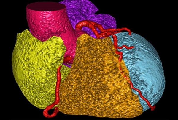 Image: AI can be used to identify different cardiac segments in CT scan (Photo courtesy of Sadeer Al-Kindi/ Houston Methodist)