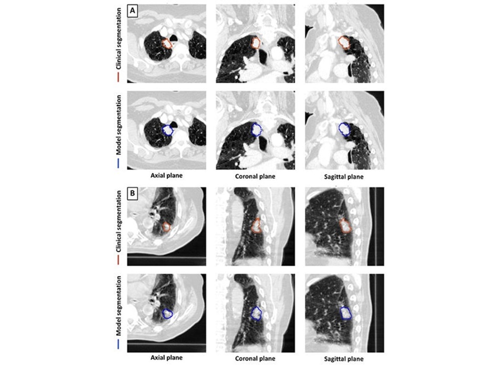 Image: Model and clinical segmentation examples (Photo courtesy of Radiology, DOI:10.1148/radiol.233029)