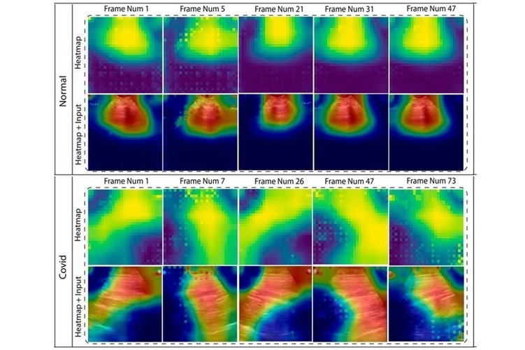 Image: Heatmaps the AI assessed to make lung disease diagnoses (Photo courtesy of COVIDx-US)