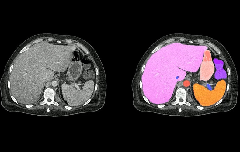 Image: Two series of abdominal CT scan slices, standard on the left and AbdomenAtlas’ organ segmentation on the right (Photo courtesy of Johns Hopkins University)