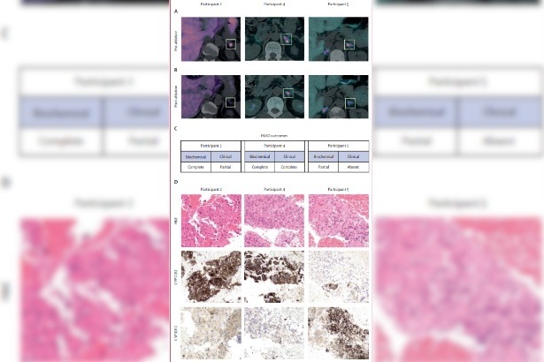 Image: Molecular imaging of the adrenal glands in three patients (Photo courtesy of QMUL)