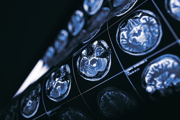 Image: The new findings warrant brain MRI surveillance recommendations for neurologically asymptomatic stage IV breast cancer (Photo courtesy of 123RF)