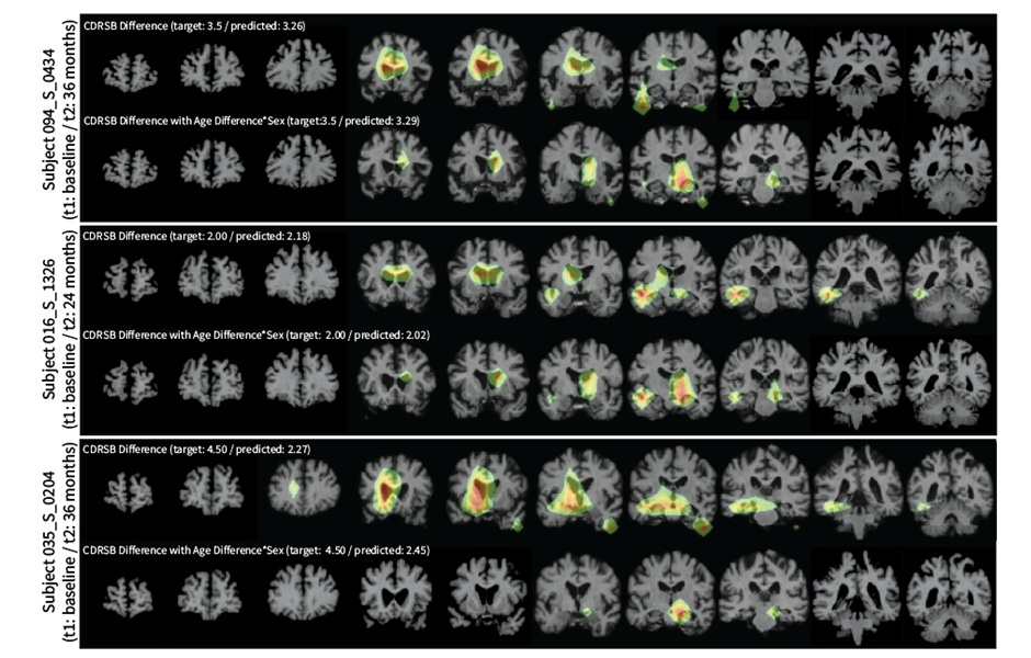 Image: This image presents heatmaps highlighting the areas LILAC focuses on when making predictions (Photo courtesy of Dr. Heejong Kim/Weill Cornell Medicine)