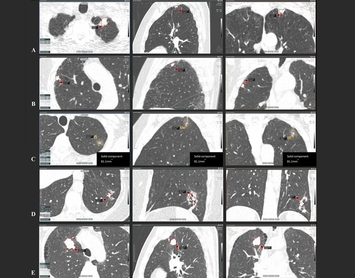 Image: Histologically confirmed lung cancer cases detected at immediate referral after baseline scan or 3-month short-term follow-up (Photo courtesy of DOI:10.1016/j.ejca.2025.115324)