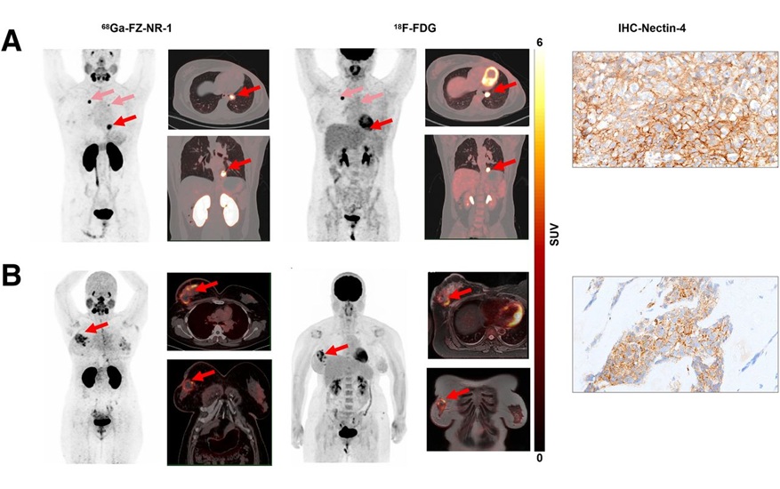 Image: 68Ga-FZ-NR-1 PET/CT images and 18F-FDG PET/CT and PET/MR images in representative Nectin-4–positive TNBC patients (Photo courtesy of The Journal of Nuclear Medicine)