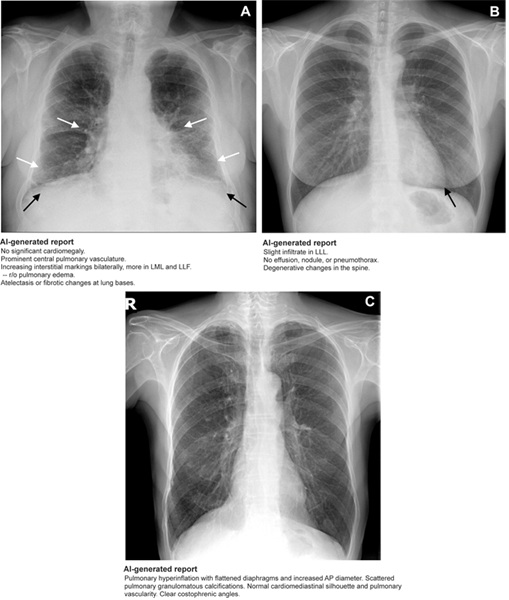 Image: Examples of chest radiograph interpretations with and without AI–generated reports (Photo courtesy of Radiology, DOI: 10.1148/radiol.241646)